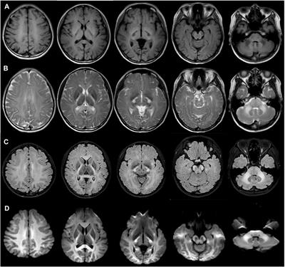 Case report: A frameshift mutation in CLCN2-related leukoencephalopathy and retinopathy